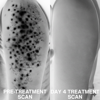 Advanced Triple-Acid Complex for Keratosis Pilaris, showing skin improvement from pre-treatment to day 4 treatment scan.