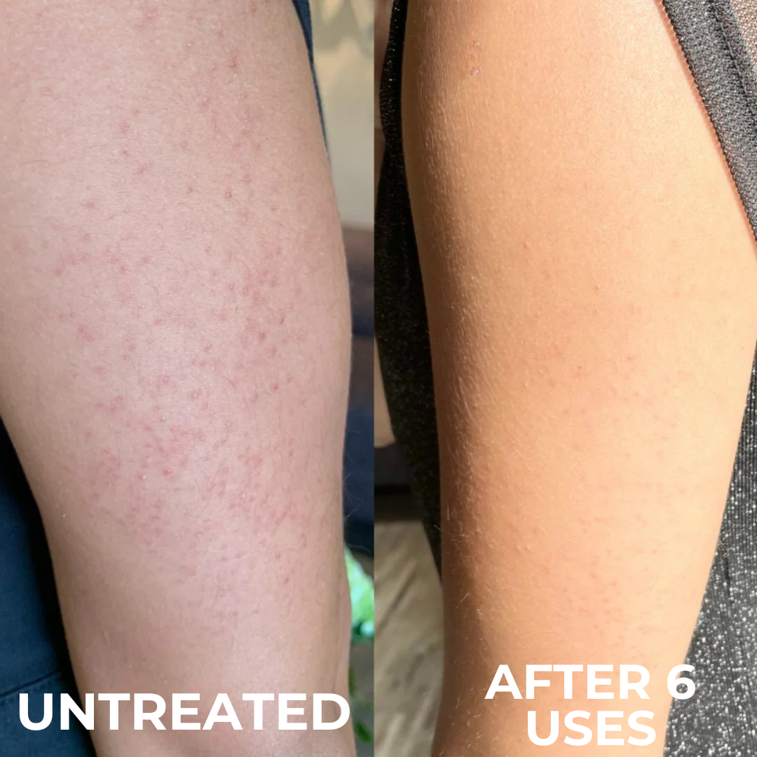 Advanced Triple-Acid Complex for Keratosis Pilaris, showing skin improvement after 6 uses.
